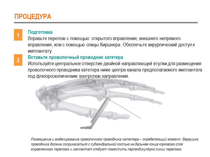 ПРОЦЕДУРА Подготовка Вправьте перелом с помощью: открытого вправления, внешнего непрямого вправления, или с помощью